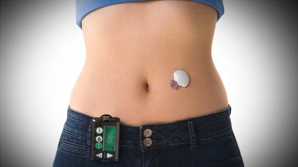 El ¨páncreas artificial¨, más cerca de ser una realidad