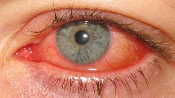Cómo prevenir y tratar la conjuntivitis