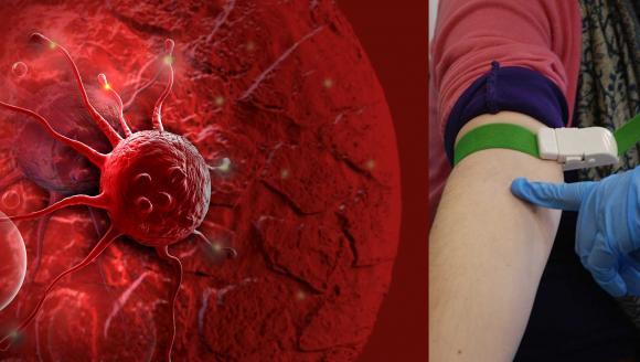 Argentina: Cada 30 minutos se diagnosticaría un cáncer de sangre