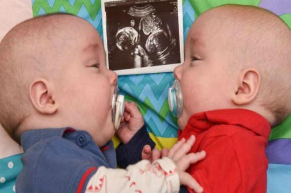 Rowan y Blaque: los gemelos que salvaron su vida dándose la mano antes de nacer