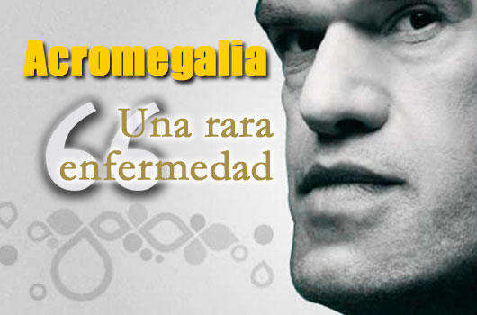 Alertan sobre los signos de la Acromegalia