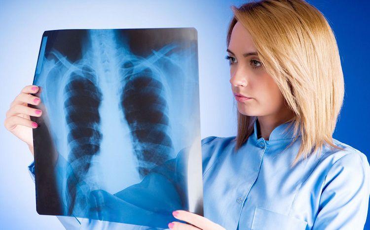 Medicamento para cáncer de pulmón (Cpcnp) evita tratarse con quimioterapia