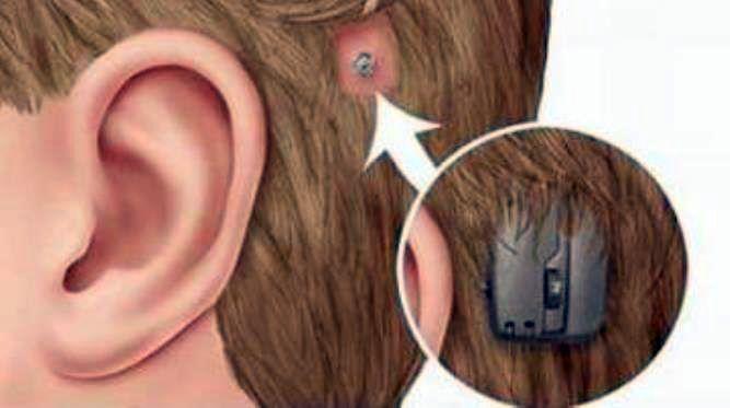 Niño de 4 años puede escuchar gracias a un implante coclear en el Hospital Provincial Evita de Lanús