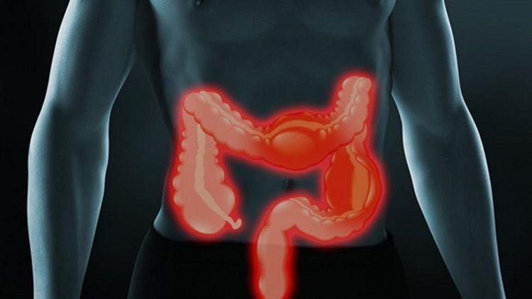 En Argentina mueren 20 personas a causa del cáncer de colon