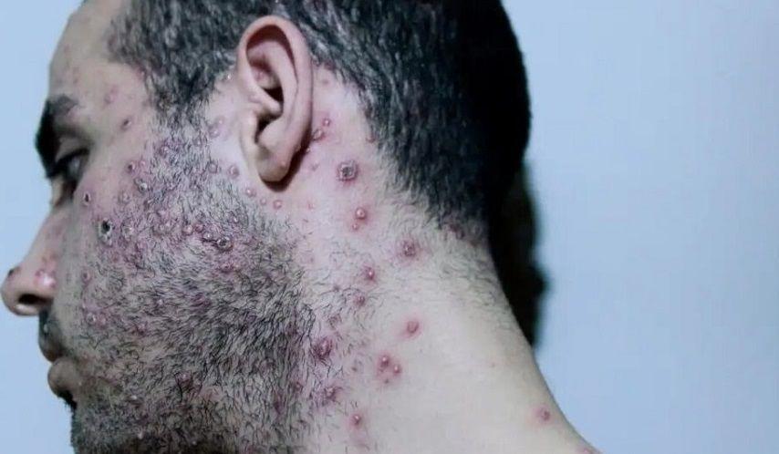 La OMS confirmó más de 5.000 casos de viruela del mono en el mundo