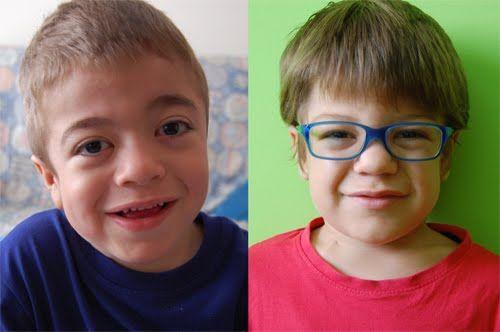 Mucopolisacaridosis: la importancia de la detección temprana