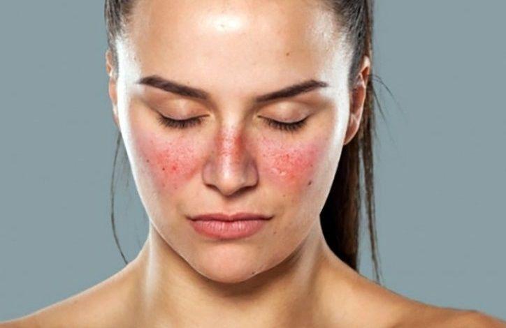 Lupus: la importancia de informarse y erradicar mitos