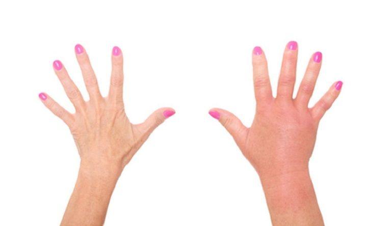 Confundir al angioedema hereditario con alergia puede poner en riesgo la vida