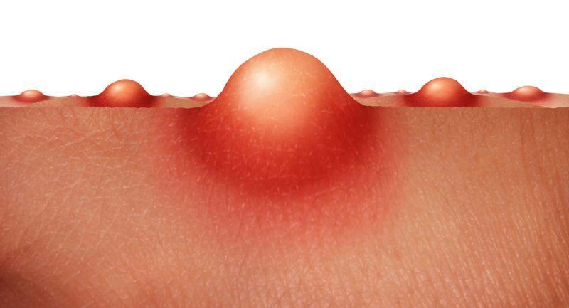 Una campaña gratuita busca detectar hidradenitis supurativa