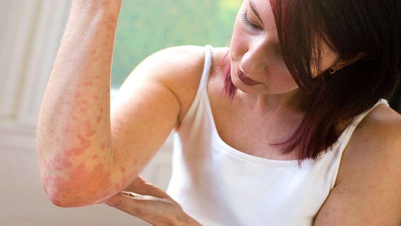 Organizan la primer Campaña de Educación sobre la Dermatitis Atópica