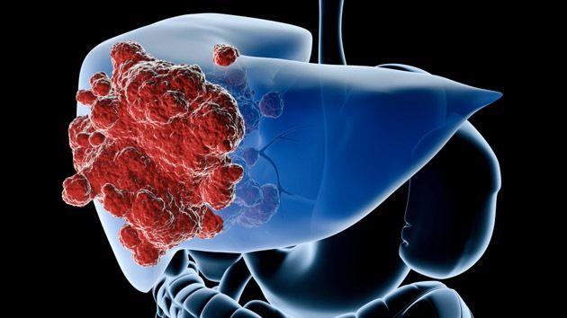 En 2030, el hígado graso causará más cáncer de hígado que la hepatitis