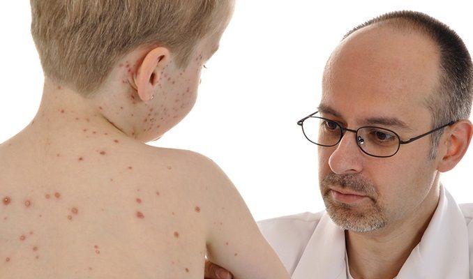 Europa: 35 personas fallecieron por sarampión, enfermedad prevenible por vacunas