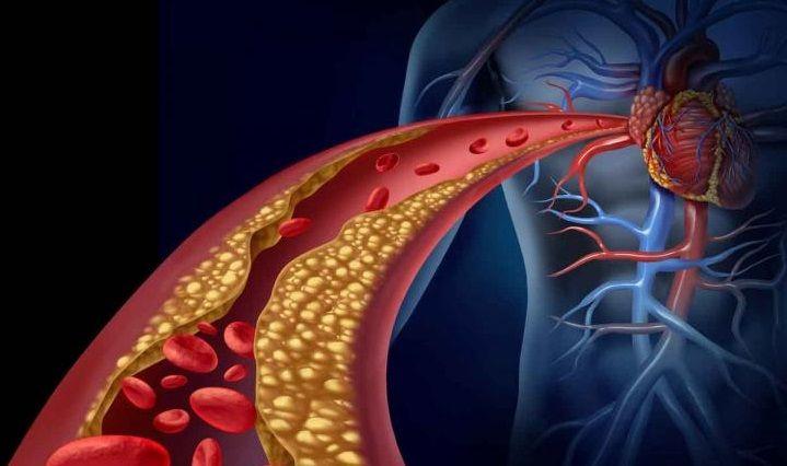 Creció en nuestro país el número de angioplastias en detrimento del by-pass coronario