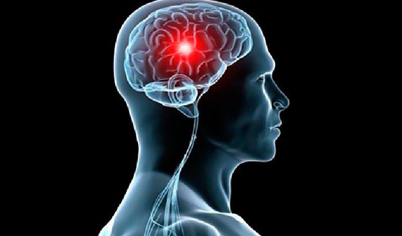 Día mundial del cerebro: Qué es y cómo detectar un ACV