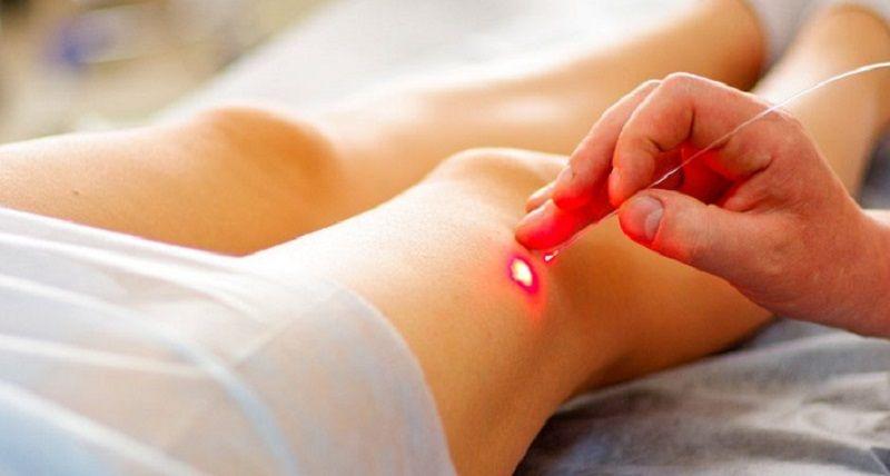 El invierno es la mejor época del año para tratar las várices