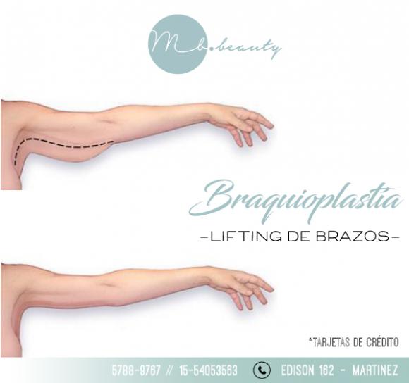 Braquioplastía