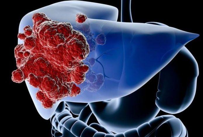 La incidencia del cáncer de hígado creció un 75% en los últimos 25 años