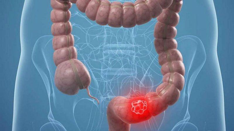 Realizarán un tamizaje para prevenir y detectar el cáncer colorrectal