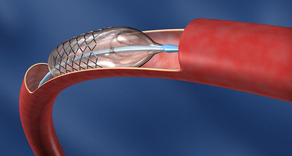 En el país se colocan más de 75 stents por día