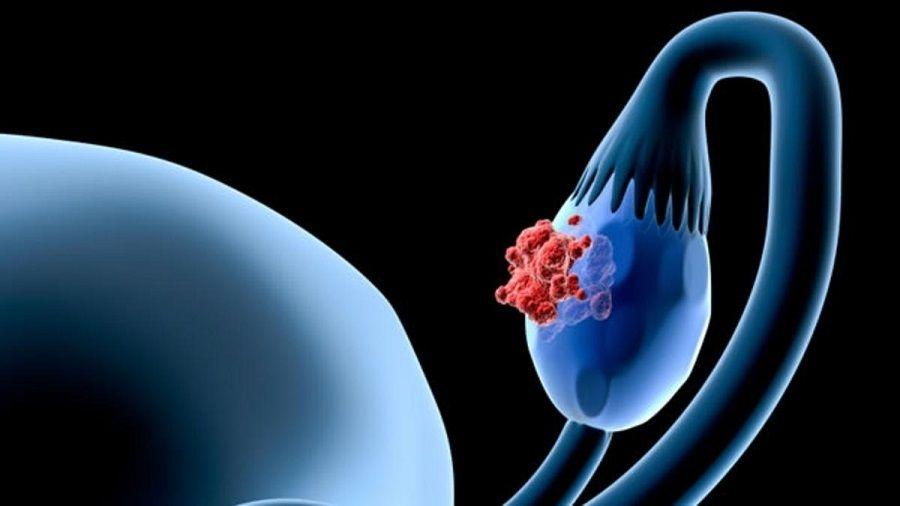 La mayoría de los cánceres de ovario tendrían su origen en las trompas de Falopio