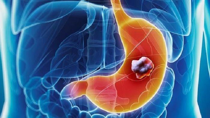 Presentan nuevo tratamiento para el cáncer de estómago avanzado