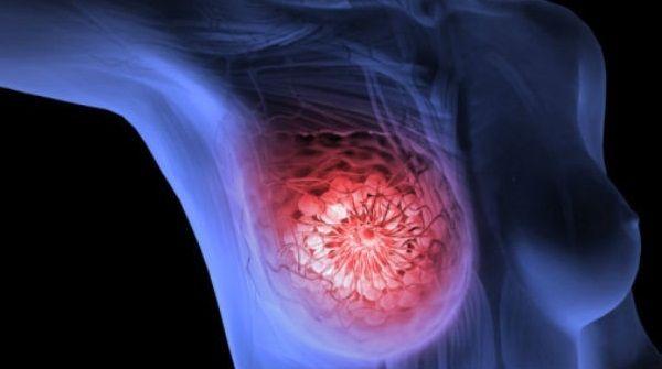 ANMAT aprobó nueva droga para tratar un tipo muy frecuente de cáncer de mama