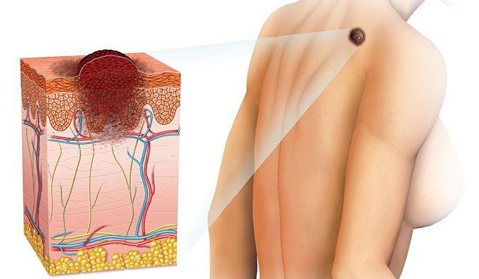 En promedio mueren más de 10 argentinos por semana a causa del melanoma