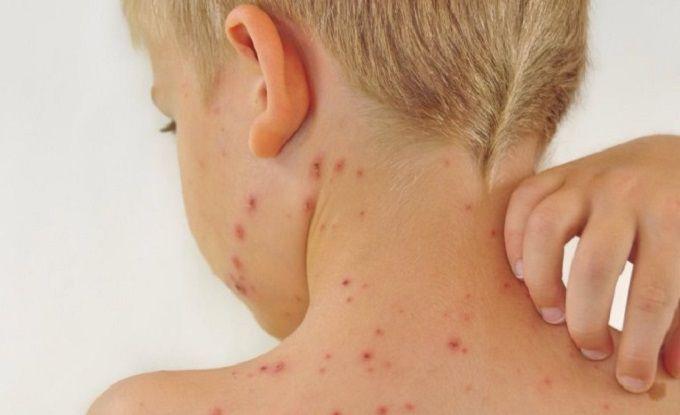 El Ministerio de Salud de la Nación confirma un caso de sarampión en Argentina