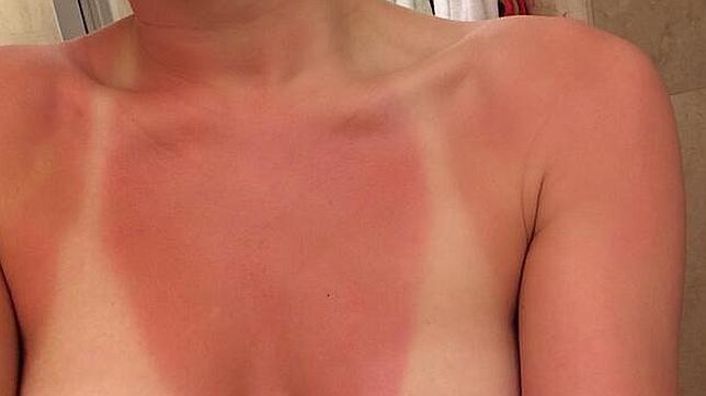 Cómo cuidarse de las quemaduras en una época crítica