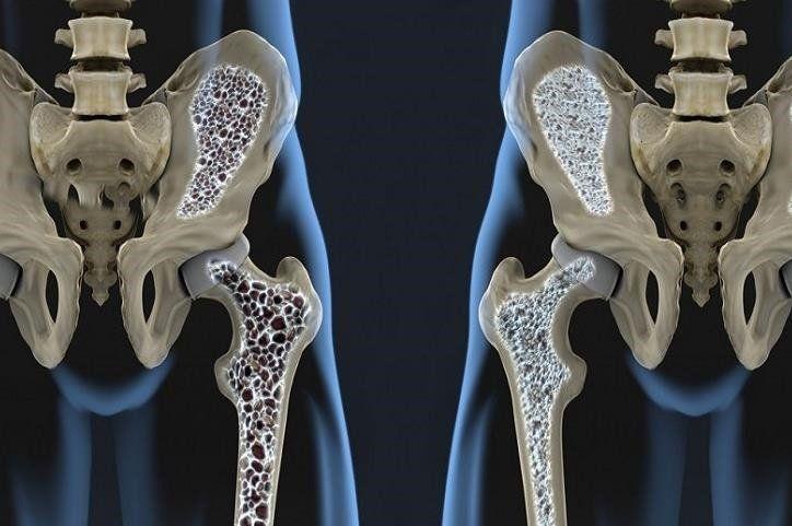 Osteoporosis: Los suplementos con calcio o vitamina D no ayudarían a prevenir fracturas