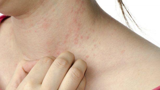 Las alergias más comunes del verano