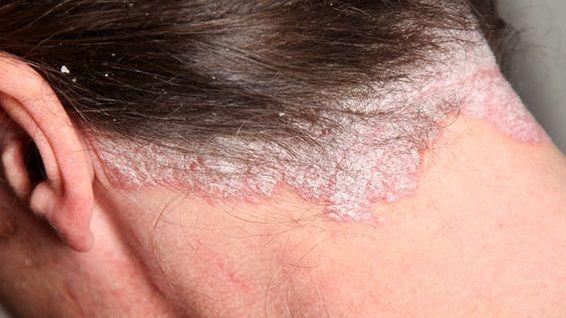 Psoriasis: Uno de cada cuatro pacientes, tiene riesgo de desarrollar artritis psoriásica