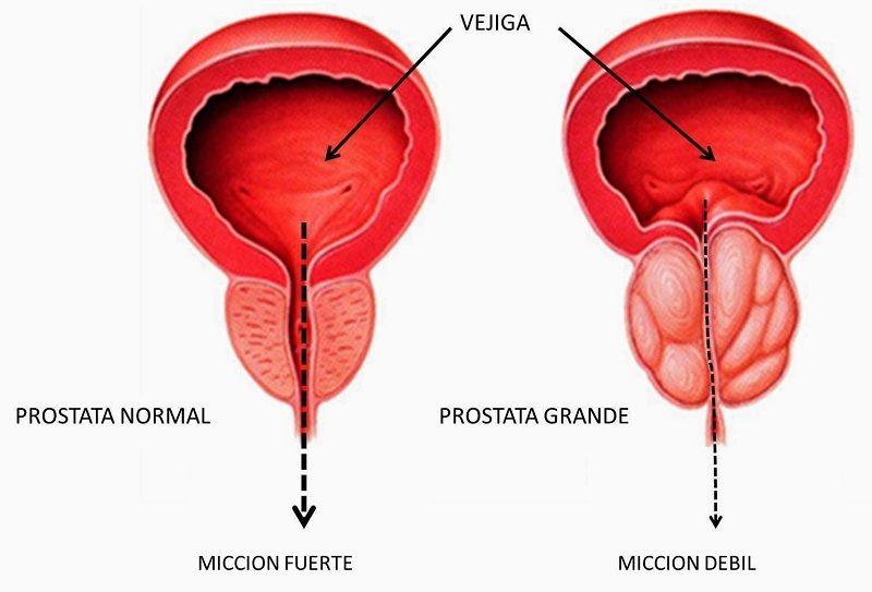 Prostatitis: Qué es, causas, síntomas, tratamiento y prevención