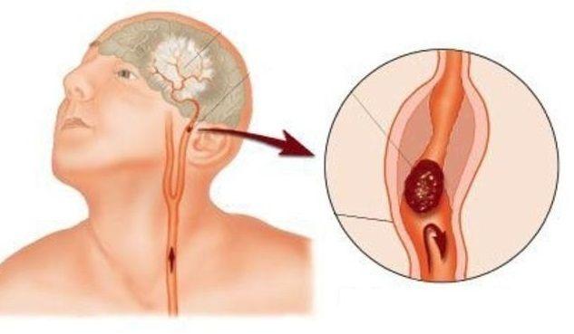Accidente isquémico transitorio: Qué es, causas, síntomas y tratamiento