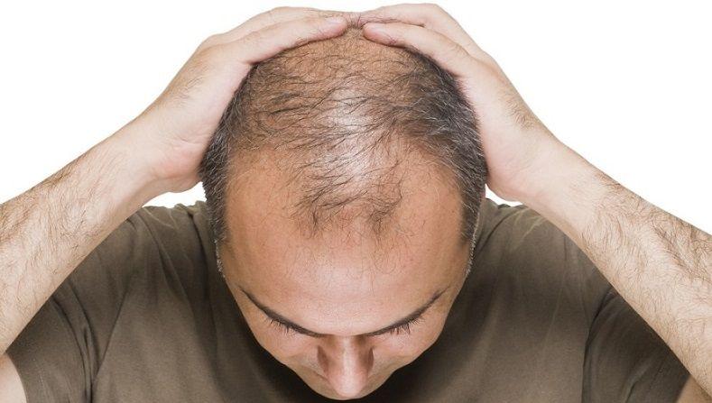 Qué funciona y que no contra la calvicie