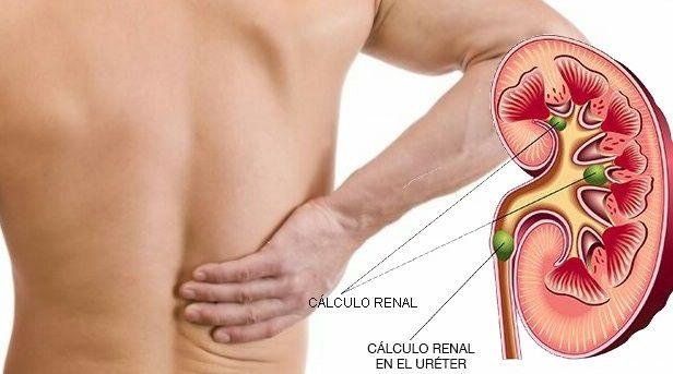 Cálculos renales: Qué son, síntomas, diagnóstico, prevención y tratamiento