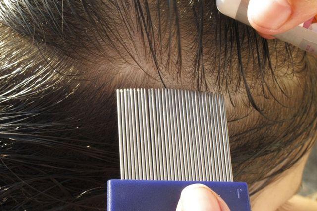 Pediculosis: Qué es, síntomas, prevención y tratamiento