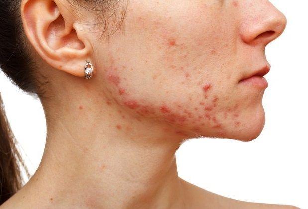Acné: Qué es, síntomas, causas, diagnóstico y tratamiento
