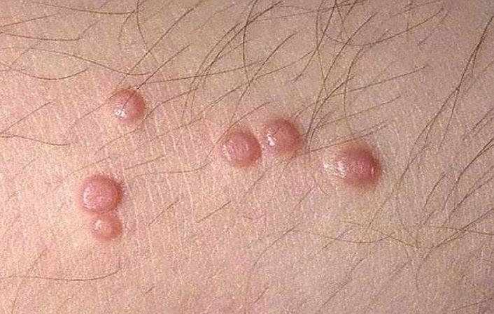 Verrugas genitales: Qué son, síntomas, causas, diagnóstico y tratatamiento