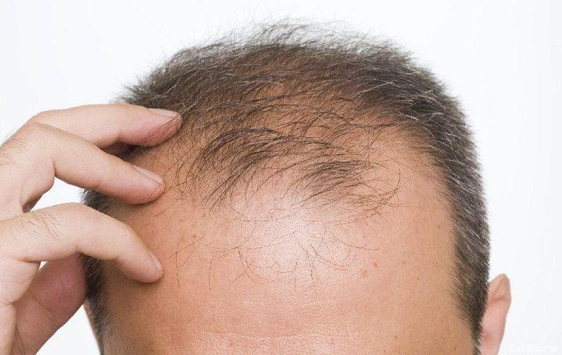 La clonación capilar se perfila como una nueva solución para la alopecia