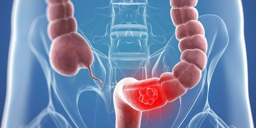 El cáncer colorrectal ocupa el segundo lugar de incidencia en Argentina
