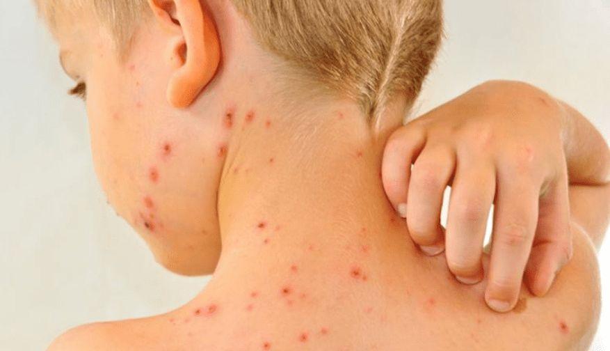 Sarampión: Qué es, síntomas, prevención y tratamiento