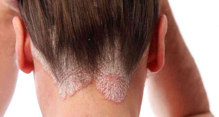 Psoriasis: 1 de cada 4 pacientes presenta la forma moderada a severa