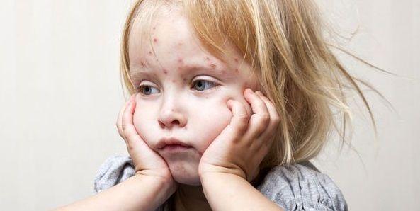 Recomendación de la SAP ante la potencial circulación del virus del sarampión