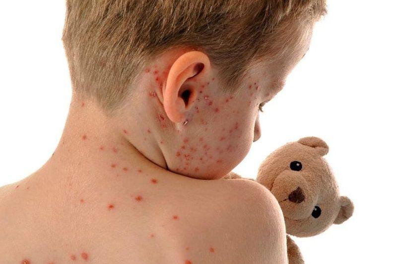 70 personas en observación y alerta por un posible brote de sarampión