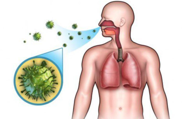 Neumonía: Qué es, síntomas, causas, diagnóstico, tratamiento y prevención