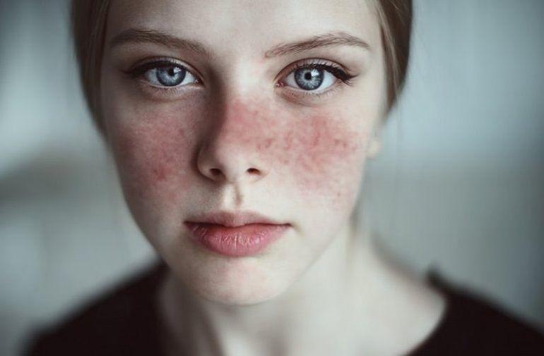 Lupus: Qué es, síntomas, causas, diagnóstico y tratamiento