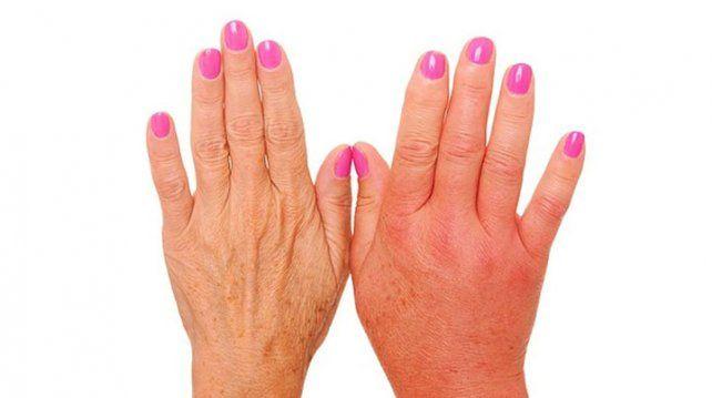 Angioedema Hereditario: Falta más información, capacitación médica y accesibilidad a los medicamentos