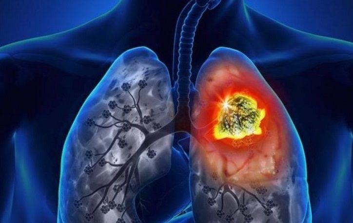 Novedades en el tratamiento de un tipo específico de cáncer de pulmón
