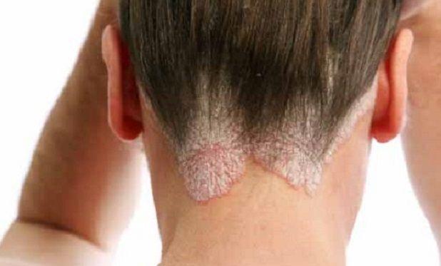 Un nuevo tratamiento para la psoriasis logra reducir el 90% de las placas en la mayoría de los pacientes